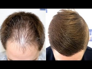 FUE Hair Transplant (2046 Grafts - DPA) By Dr Juan Couto - FUEXPERT CLINIC, Madrid, Spain