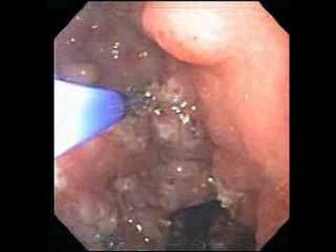 Gastric Antral Vascular Ectasia