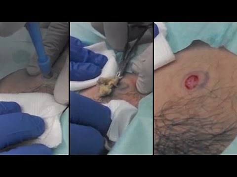 The World’s Most Massive Cyst Popped On Camera