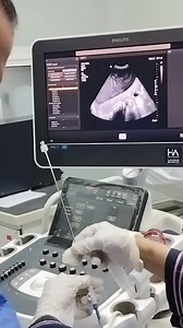 63K views · 445 reactions | #Liver_abscess A liver abscess is a...