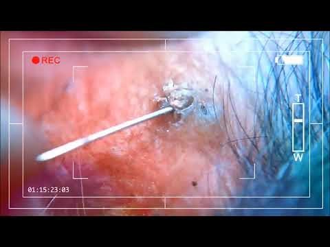 blackheads - Removal from deep inside skin