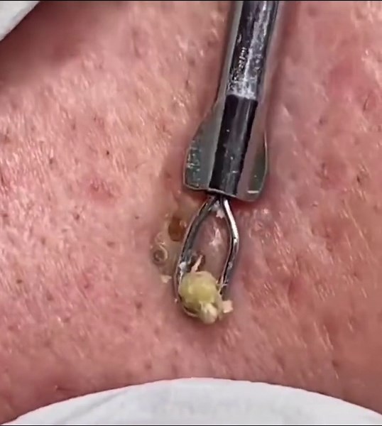 Extraction of three big blackheads #acne #acmeshot #cyst #pimple #cystpopping #blackhead #fyp