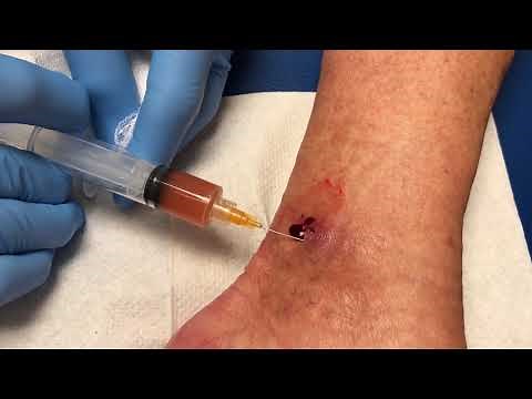 PRP for chronic venous ulcer