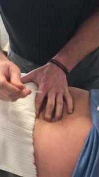 Dry Needling of the Low Back
