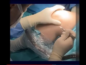 Lateral ExtraArticular Tenodesis