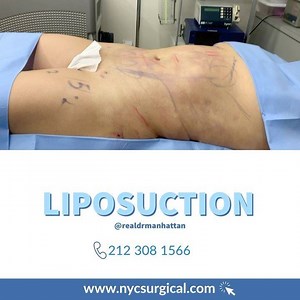 Liposuction #liposuction #nyc #manhattan #buildingbody #boardcertified #plasticsurgeon #surgeonlife #cosmetics #cosmeticindustry #femalesurgeon | Manhattan Surgical Care | Facebook