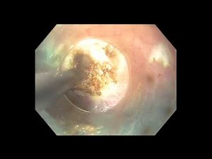 Poem with Incremental Myotomy and Intraoperative Endoflip • Video • MEDtube.net