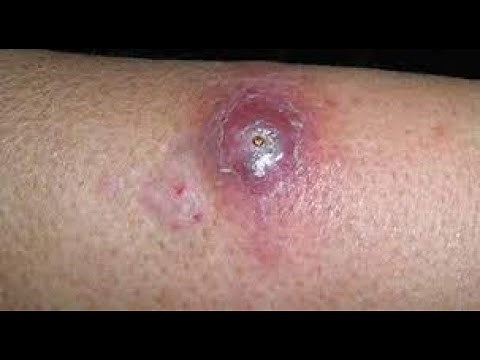 Incision and drainage Deep Abscess or Hematoma CPT code - simplify medical coding