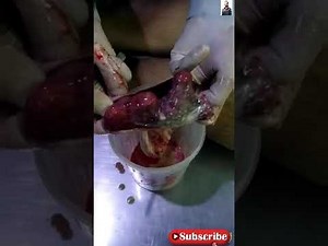 Postmortem Female Dead Body/Autopsy Female Body