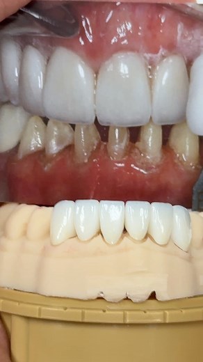 87K views · 122 reactions | Lower Anterior Amber Press Signatures! Case from Dr. Derek Magers in Missouri! Ascend Dental Design EnvisionTEC HASSBio Hassambassador Kr #HASSBIO #hassambassador_kr | Luke Kahng | Facebook