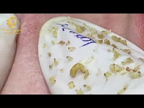 Blackheads removal by Loan Nguyen (379)