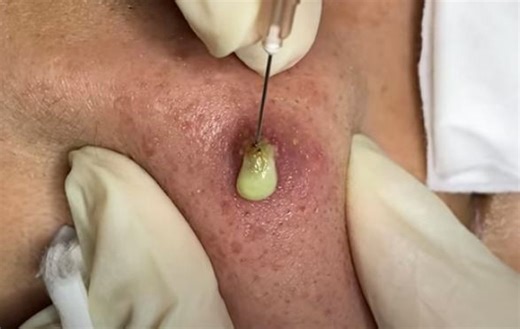 Infected Pimple Popping