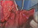 Gastric Cancer Surgery - Subtotal Gastrectomy • Video • MEDtube.net