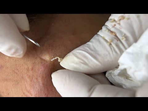 Removal big Acne