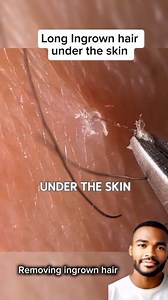 85K views · 298 reactions | Ingrown hair under the skin and it's long hair removal  #fblifestyle #ingrownhair #satisfyingvideo #everyonehighlightsfollowers | Removing Hair Ingrown | Facebook