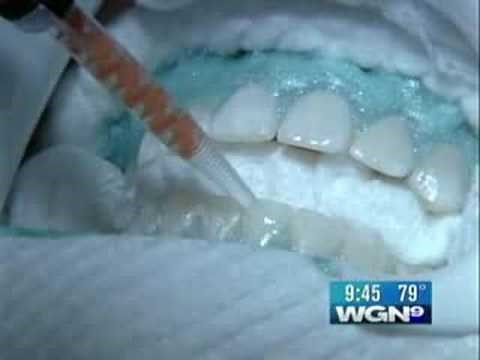 Teeth Whitening for Teenagers