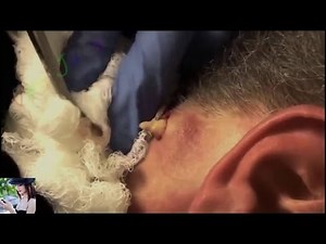 acne treatment at home - squeeze pimple horror 2016-