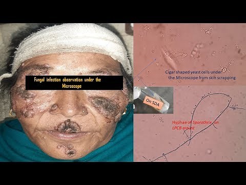 Fungal infection under the Microscope Sporotrichosis