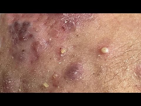 Acne Treament Under The Skin #055