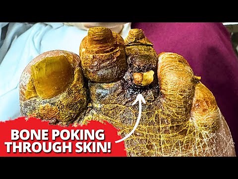 INSANE Toe Bone Sticking Out! 😱 Extreme Nail Cut & Dead Skin Removal