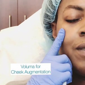 Voluma injections for cheek augmentation - a simple, painless and quick procedure!