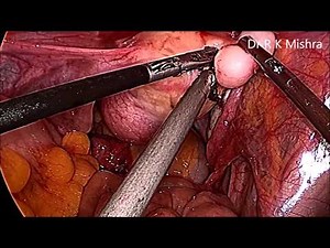 Laparoscopic Ovarian Cystectomy and Myomectomy by Dr R K Mishra