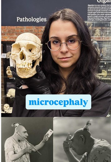 Understanding Microcephaly: Features and Insights