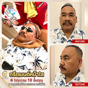 137K views · 1K reactions | Review ทรีตเมนต์หน้าใส 4 โปรแกรม 10...