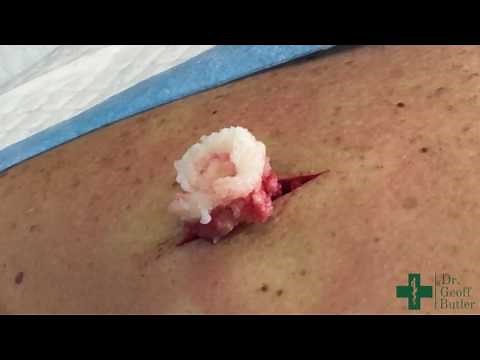 Removal of an Epidermal cyst on the upper back