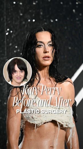 Drs. Wendy Lamara & Soobin Lim | Monterey, San Jose, California on Instagram: "Katy Perry’s Plastic Surgery 💅 #katyperry #plasticsurgery #filler"