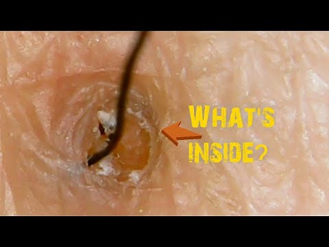 Amazing Extraction|part 5| Blackheads |Pilimultigemini | Hair Ingrown |