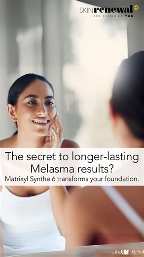 The Basement Membrane Breakthrough Pigment problems like Melasma aren't just surface deep; they're rooted in structural skin damage. Matrixyl Synthe 6 helps rebuild your skin's basement membrane (BM), increasing collagen IV by 42% and laminin-5 by 75%. Why does that matter? Because a stronger BM stops pigment from leaking into deeper layers. When paired with Skin Renewal's doctor-led Melasma treatments, this peptide helps prevent recurrence, making results last longer and look better. It's not j