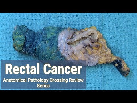 Rectal Cancer + Lymph Node Hunt | Anatomical Pathology Grossing Review Series