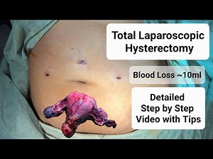Total Laparoscopic Hysterectomy | Detailed Step by Step Procedure with Tips - Dr Tayyab Riaz Ch