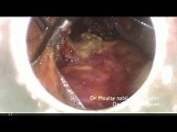 Infracolic Omentectomy • Video • MEDtube.net