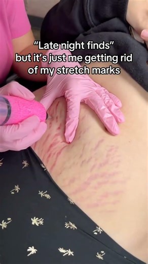 Stretch Mark Camouflage Tattoo | Tattoo Late Night Find That Actually Worked
