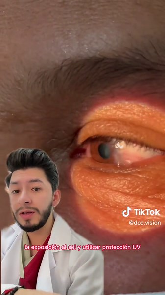 Cuidados de la carnosidad. #optometria #oftalmologo #salud #tips