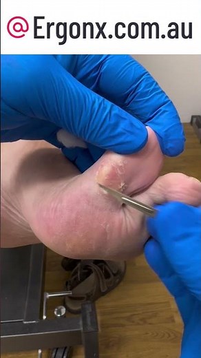 Satisfying Big Toe Callus Removal by Expert Podiatrist #Podiatry #FootCare