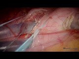 Laparoscopic Resection of Two Gastric Tumors • Video • MEDtube.net