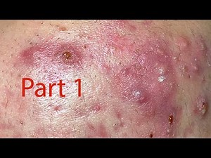 Make your Acne Treatment Huong Da Nang#488 part 1 | acne 2022
