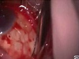 Scleral Buckling Procedure - Eyetube