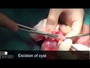 Excision Of Epididimal Cyst Scrotal Exploration YouTube