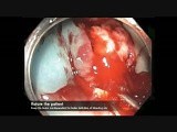 Cecum-EMR Bleed-Position Change-D • Video • MEDtube.net
