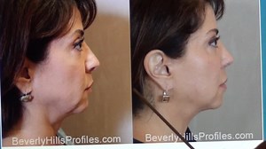 Female Facelift Patient| Beverly Hills Profiles