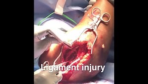 Management of Unstable Elbow and Wrist Injuries: Ditch the Ex-Fix