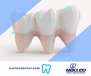 #Partial #dentures are a better option than a full denture to replace a missing tooth in the lower jaw, especially if some #teeth can be saved. . Phone: 915 308 0101 nucleodental.com . #NucleoDental #ElPasoTx🇺🇸 #CiudadJuarez🇲🇽 #NewMexico #dentalclinicnearme #oralcare #oralhealth #dentaltourism #dentaltourismmexico #dentalimplantsmexico #dentalimplantsjuarez #bestdentalserviceintown✌️🦷 #cosmeticdentistry #dentalservice #orthodonticservice #fullmouthrehabilitation #americaninsurance #transpor
