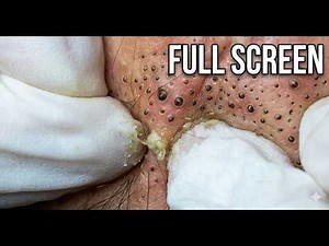 Blackhead Removal Explained | How to Get Rid of Acne & Clear Skin Fast