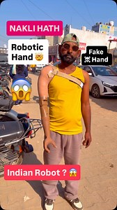 35K views · 9.9K reactions | Patient from Bangalore  | Above Elbow Myoelectric Hand | Bionic Hand In India | Prosthetic Hand | Artificial Hand | Nakli Hath | Zeus Hand | I-Limb Hand Ossur | Ossur Bionic Hand | Covvi Hand | Indian Robotic Hand | #prosthetics #bionichand #naklihath #artificiallimb #myoelectrichand | Credence Prosthetic India Pvt. Ltd. | Facebook