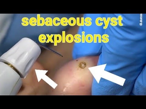 4 Terrifying Sebaceous Cyst Explosions Caught on Camera