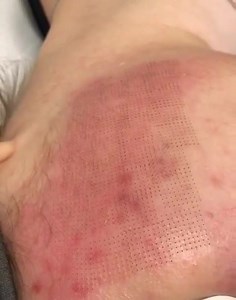 CO2 Laser Skin Resurfacing For Acne Scarring 🥳 This type of laser helps to improve skin texture, lighten pigmentation, wrinkles, reduce pore size, and smooth out scars (including acne scars) and stretch marks. . Clients normally experience around 5-7 days downtime. Book a virtual consultation today, you can book online SuddenlySlimmer.com or Call or Text 602-560-9066 Location: 3313 E. Indian School Rd. Phoenix, AZ! Suddenly Slimmer has been In practice since 1988! Source: https://www.suddenlysl